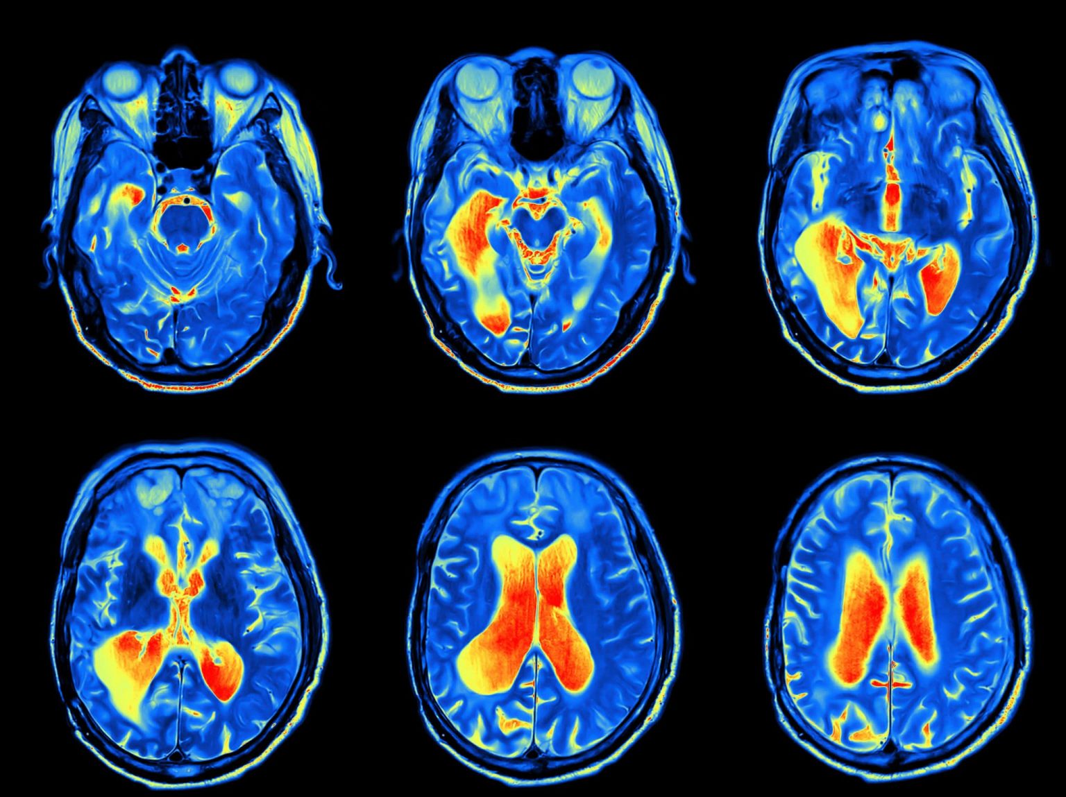A series of MRI images of the brain during a skull base tumor exam.